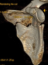 Scapula Neck Fracture